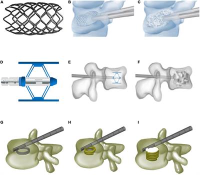 Innovative minimally invasive implants for osteoporosis vertebral compression fractures